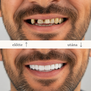 SMILEFIT PRO – REGULOWANY ZESTAW ZĘBÓW DLA IDEALNEGO UŚMIECHU