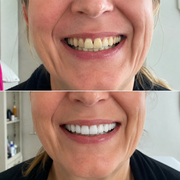 SMILEFIT PRO – REGULOWANY ZESTAW ZĘBÓW DLA IDEALNEGO UŚMIECHU